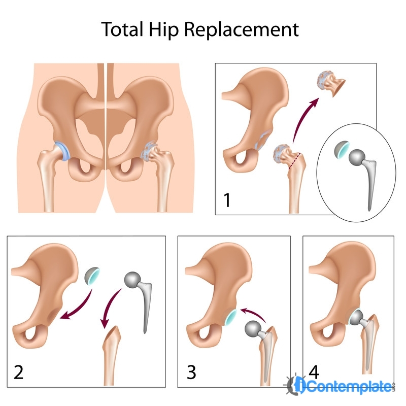 Hip Surgeon Los Angeles