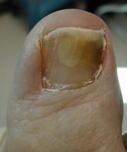 What Is Toenail Fungus