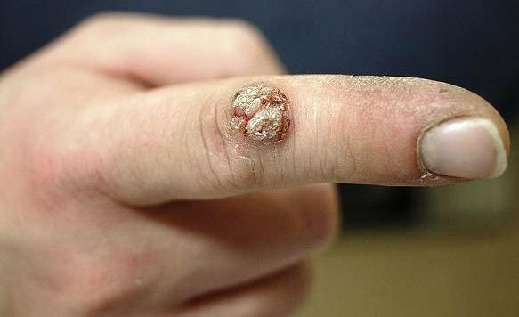 Wart Removal – Important Precautions and Prevention Ways