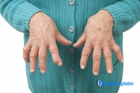 Holistic Strategies For Managing Osteoarthritis