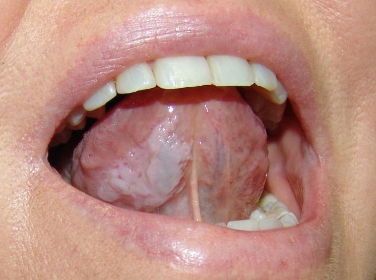 The Symptoms And Treatment Of Leukoplakia At The Initial Stage