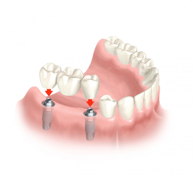 What Is Involved In A Dental Implant Surgical Procedure?