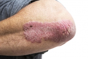 6 Things To Consider When Your Psoriasis Isn't Improving